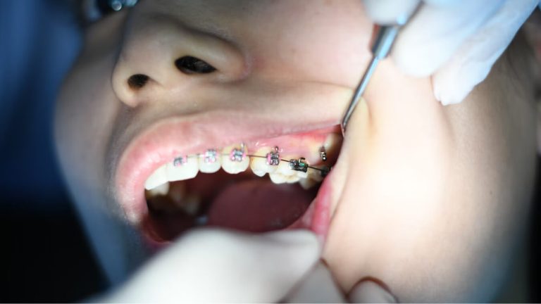 Realizando ortondoncia en una boca